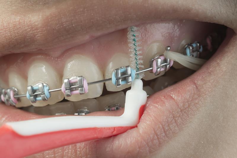 Braces in Lebanon and Mt Juliet, TN Oxford Orthodontics